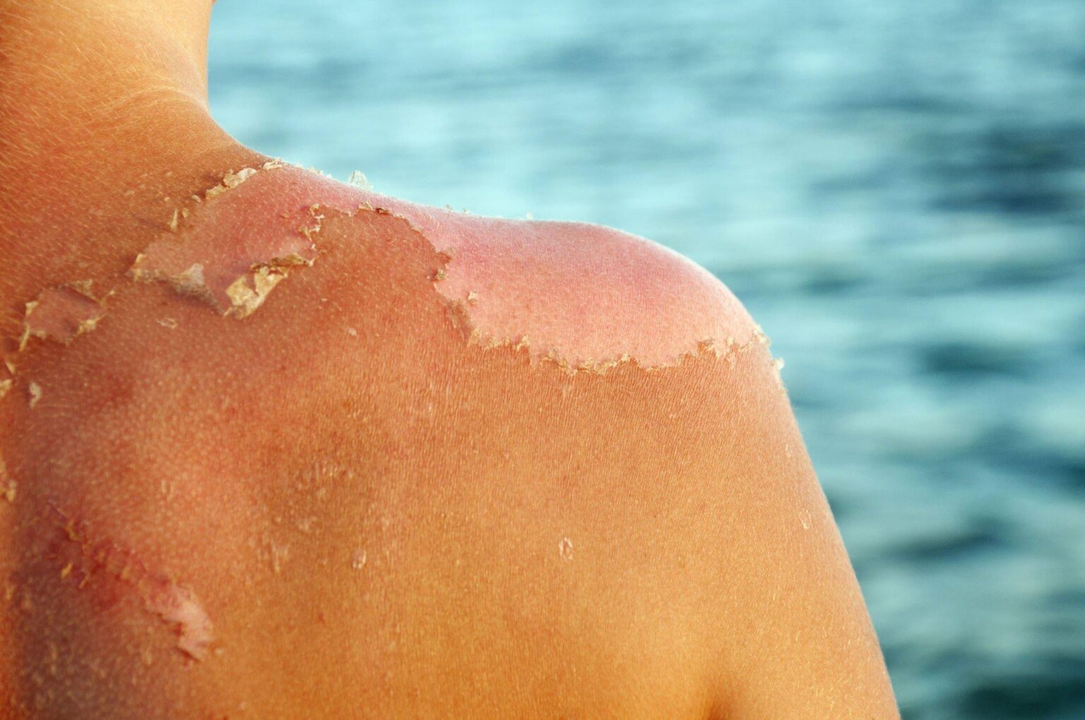 skin-cancer-warning-signs